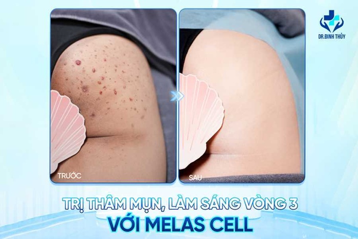 “Sự thật” công nghệ Melas Cell: Dứt thâm, mụn, sần sùi vòng 3 chỉ với một liệu trình?